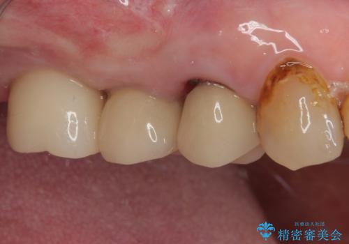 破折して抜歯となった奥歯 抜歯即時埋入・即時荷重インプラントによる補綴治療の治療後