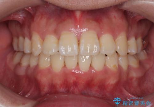 前歯のデコボコを抜歯矯正で改善した症例|目立ちにくい審美装置を使用の治療後