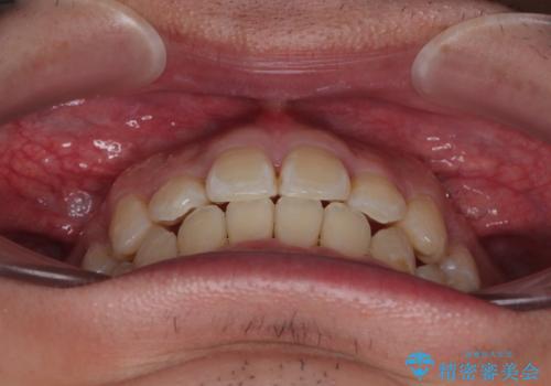 前歯のデコボコを抜歯矯正で改善した症例|目立ちにくい審美装置を使用の治療後