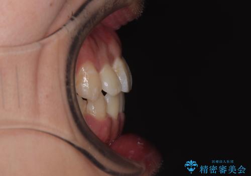 前歯のデコボコを抜歯矯正で改善した症例|目立ちにくい審美装置を使用の治療後