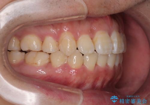 前歯のデコボコを抜歯矯正で改善した症例|目立ちにくい審美装置を使用の治療後