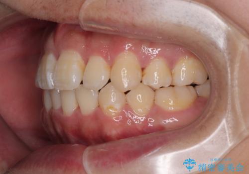 前歯のデコボコを抜歯矯正で改善した症例|目立ちにくい審美装置を使用の治療後