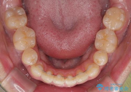 前歯のデコボコを抜歯矯正で改善した症例|目立ちにくい審美装置を使用の治療後