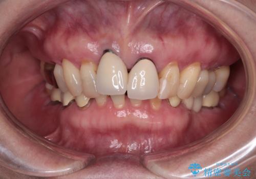 【海外から通院】統一感のない前歯をきれいに オールセラミッククラウン治療の治療前
