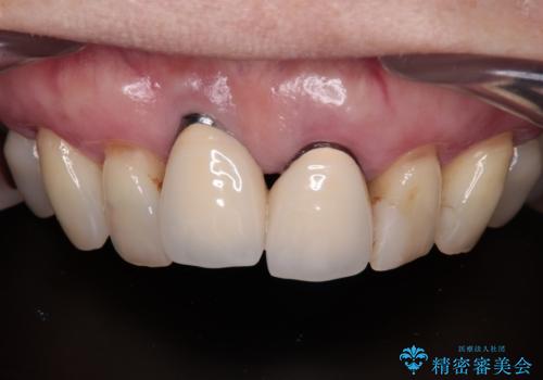 【海外から通院】統一感のない前歯をきれいに オールセラミッククラウン治療の治療前