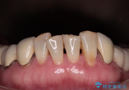 【海外から通院】統一感のない前歯をきれいに オールセラミッククラウン治療の治療前