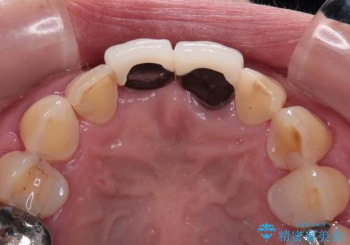 【海外から通院】統一感のない前歯をきれいに　オールセラミッククラウン治療の治療前