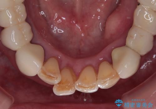 【海外から通院】統一感のない前歯をきれいに オールセラミッククラウン治療の治療前
