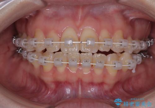 早く・確実に歯並び改善|目立ちにくいワイヤー矯正の治療中