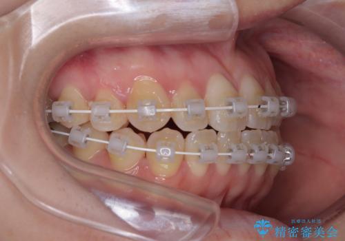 早く・確実に歯並び改善|目立ちにくいワイヤー矯正の治療中