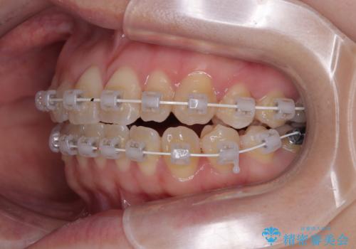 早く・確実に歯並び改善|目立ちにくいワイヤー矯正の治療中