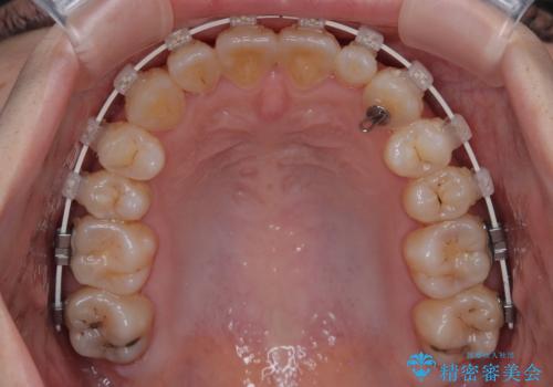 早く・確実に歯並び改善|目立ちにくいワイヤー矯正の治療中