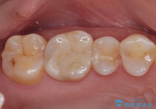 詰め物が欠けたまま放置は危険?見えにくい奥歯のトラブルに注意