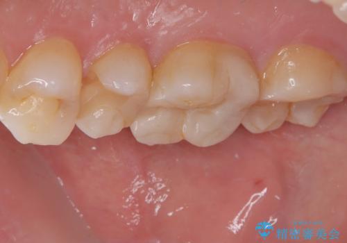 詰め物が欠けたまま放置は危険?見えにくい奥歯のトラブルに注意の治療前