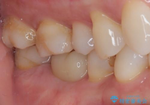 詰め物が欠けたまま放置は危険?見えにくい奥歯のトラブルに注意の治療前