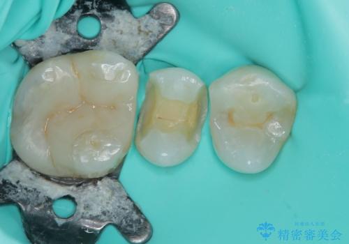 詰め物が欠けたまま放置は危険?見えにくい奥歯のトラブルに注意の治療中