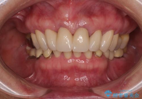 【海外から通院】統一感のない前歯をきれいに オールセラミッククラウン治療の治療後