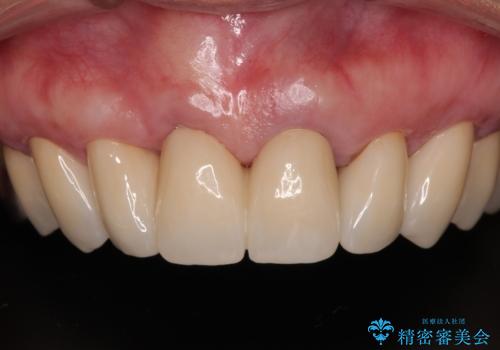 【海外から通院】統一感のない前歯をきれいに　オールセラミッククラウン治療の治療後