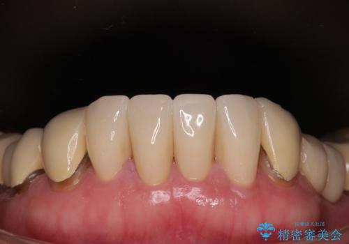 【海外から通院】統一感のない前歯をきれいに オールセラミッククラウン治療の治療後