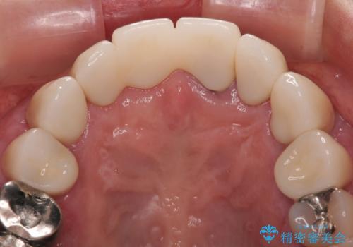 【海外から通院】統一感のない前歯をきれいに　オールセラミッククラウン治療の治療後