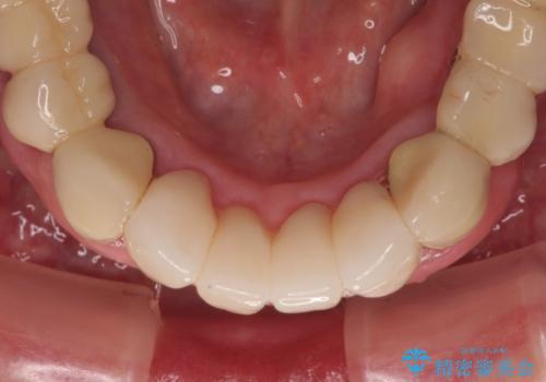 【海外から通院】統一感のない前歯をきれいに　オールセラミッククラウン治療の治療後