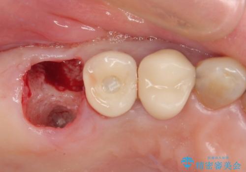 破折して抜歯となった奥歯 抜歯即時埋入・即時荷重インプラントによる補綴治療の治療中