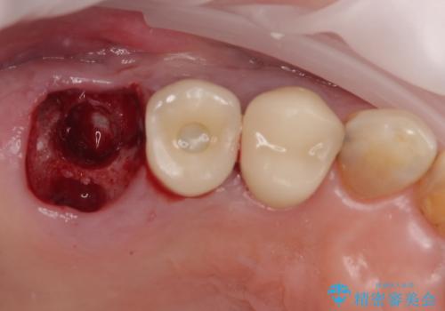 破折して抜歯となった奥歯 抜歯即時埋入・即時荷重インプラントによる補綴治療の治療後