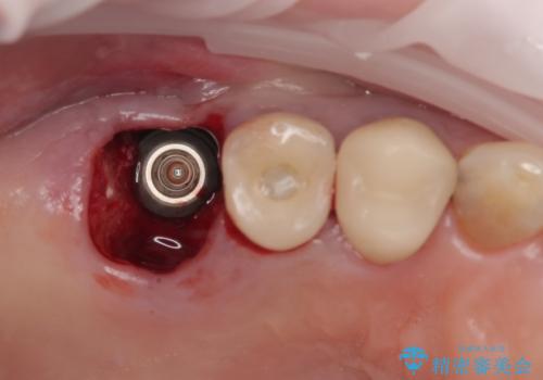 破折して抜歯となった奥歯　抜歯即時埋入・即時荷重インプラントによる補綴治療の治療中