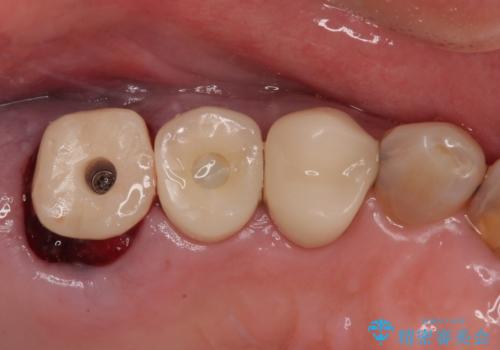 破折して抜歯となった奥歯　抜歯即時埋入・即時荷重インプラントによる補綴治療の治療中