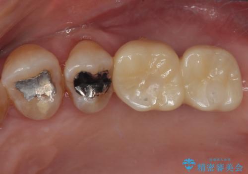 骨量の少ない上顎大臼歯　骨補填材を用いない短期間インプラント治療の治療後