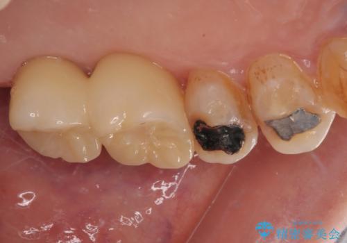 骨量の少ない上顎大臼歯 骨補填材を用いない短期間インプラント治療の治療後