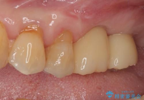 骨量の少ない上顎大臼歯 骨補填材を用いない短期間インプラント治療の治療後