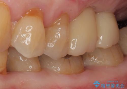 骨量の少ない上顎大臼歯 骨補填材を用いない短期間インプラント治療の治療後