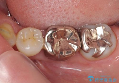 目立つ銀歯をオールセラミッククラウンで自然に|20代女性の審美補綴症例の治療前