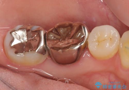 目立つ銀歯をオールセラミッククラウンで自然に|20代女性の審美補綴症例の治療前