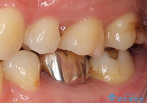 目立つ銀歯をオールセラミッククラウンで自然に|20代女性の審美補綴症例の治療前