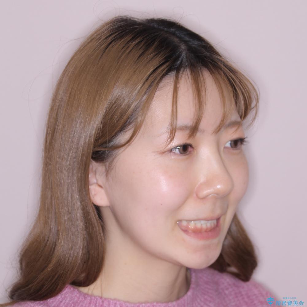 【モニター】デコボコとクロスバイトの前歯 ワイヤー装置での抜歯矯正の治療後(顔貌)