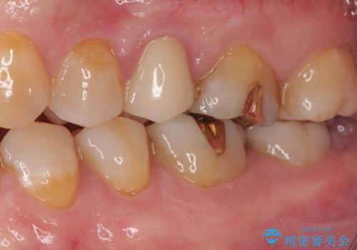 「やり替えるなら良いものを」精度重視の補綴治療を選択された症例の治療後