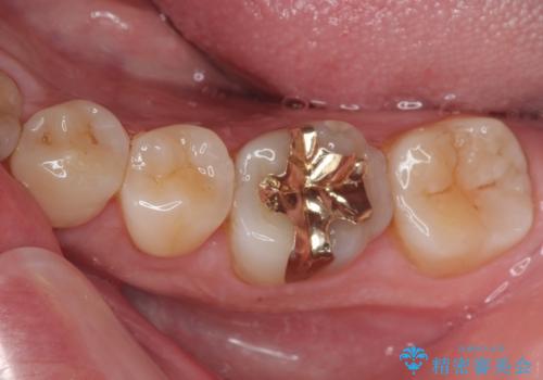 「やり替えるなら良いものを」精度重視の補綴治療を選択された症例の治療後