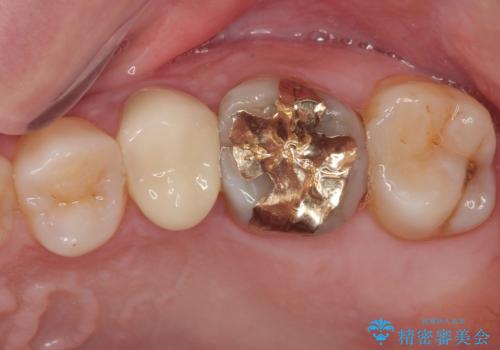 「やり替えるなら良いものを」精度重視の補綴治療を選択された症例の治療後