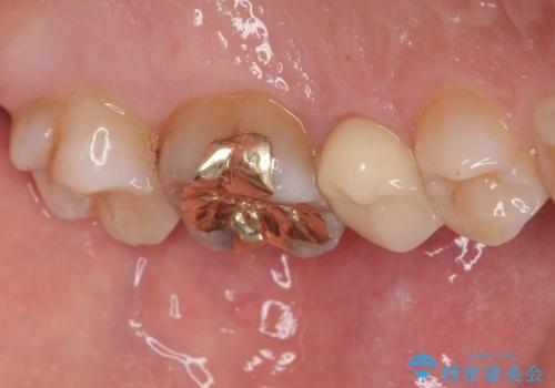 「やり替えるなら良いものを」精度重視の補綴治療を選択された症例の治療後