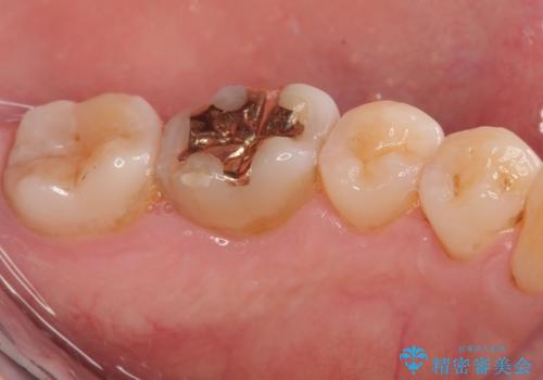「やり替えるなら良いものを」精度重視の補綴治療を選択された症例の治療後