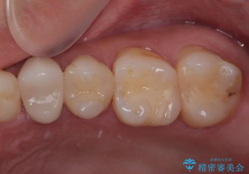 詰め物が欠けたのでやり替えたい セラミックインレー修復の治療後