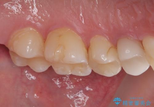 詰め物が欠けたのでやり替えたい　セラミックインレー修復の治療後