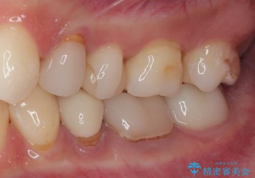 詰め物が欠けたのでやり替えたい　セラミックインレー修復の治療後