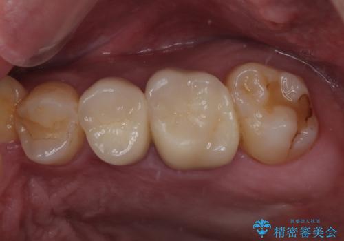 奥歯がたまにしみる MTAによる生活歯髄療法・オールセラミッククラウンの症例 治療後