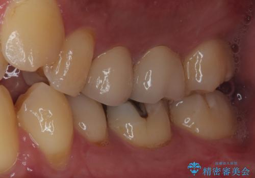 奥歯がたまにしみる MTAによる生活歯髄療法・オールセラミッククラウンの治療後