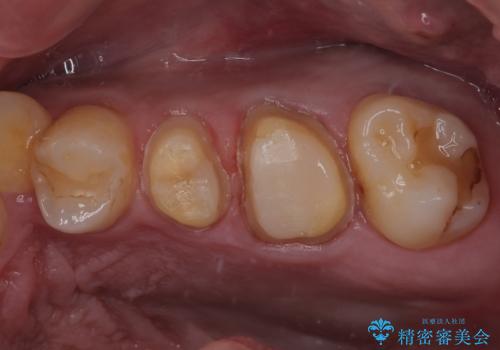 奥歯がたまにしみる　MTAによる生活歯髄療法・オールセラミッククラウンの治療中