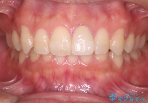 【インビザラインとセラミック】前歯を綺麗にの治療後