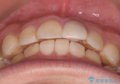 【インビザラインとセラミック】前歯を綺麗にの治療後